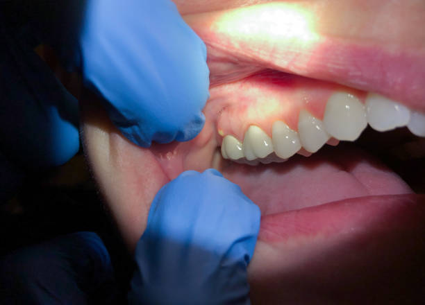 Best Emergency Dentist for Lost Fillings or Crowns in Marlow Heights, MD